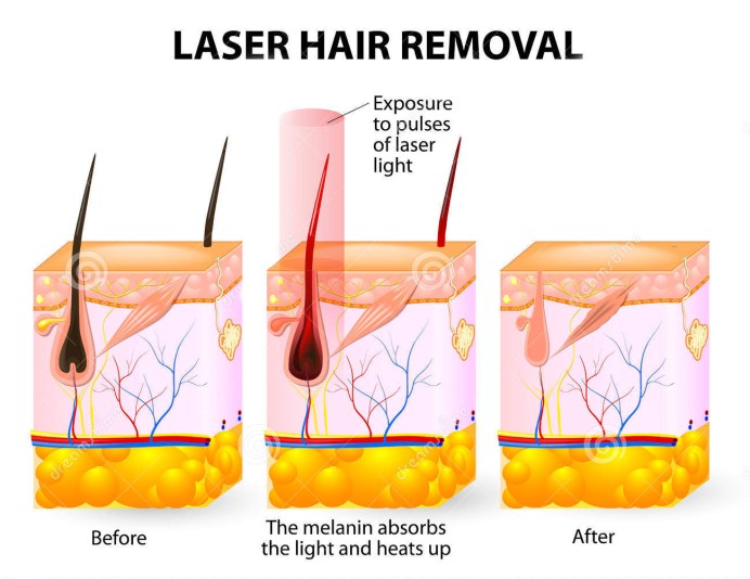 hair-removal-laser